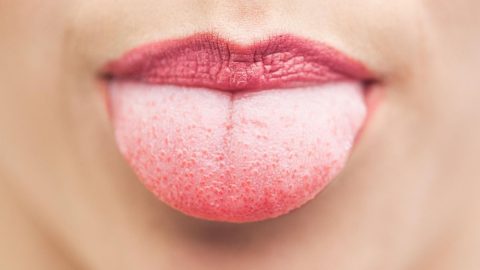 فطريات اللسان : الأعراض وطرق العلاج