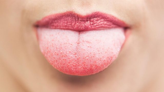 فطريات اللسان : الأعراض وطرق العلاج