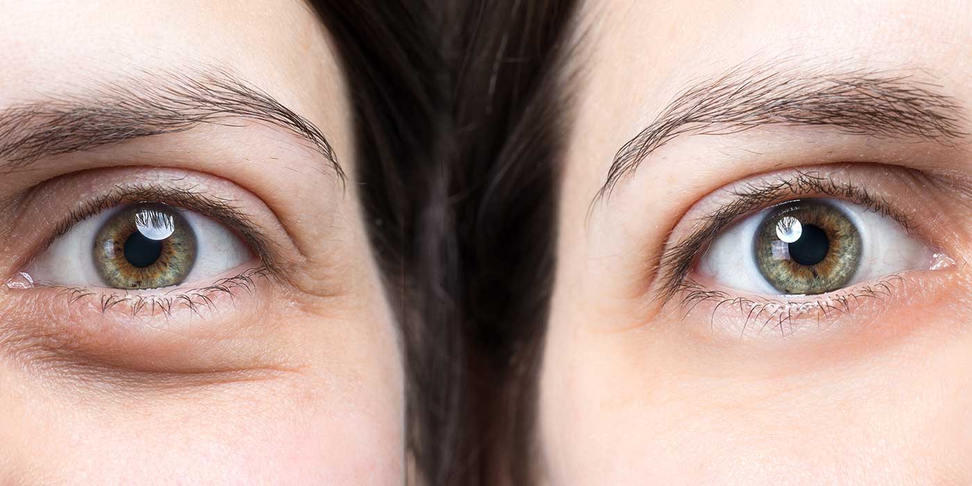 3 علاجات تجميلية للهالات السوداء