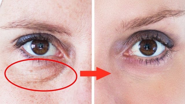 3 علاجات تجميلية للهالات السوداء حديثة وسريعة المفعول