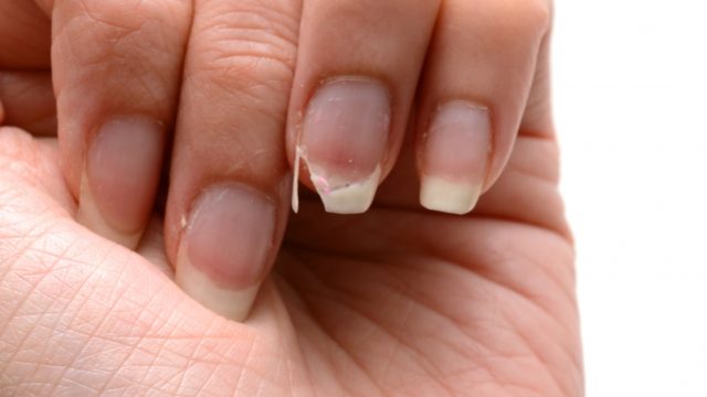تكسر الأظافر: الأسباب والعلاج