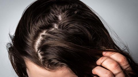 علاج الشعر الدهني بوصفات طبيعية فعالة