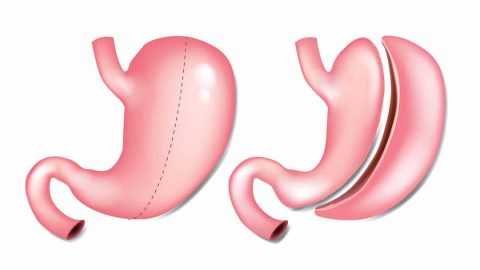 تكميم المعدة وأهم النصائح التي يجب اتباعها