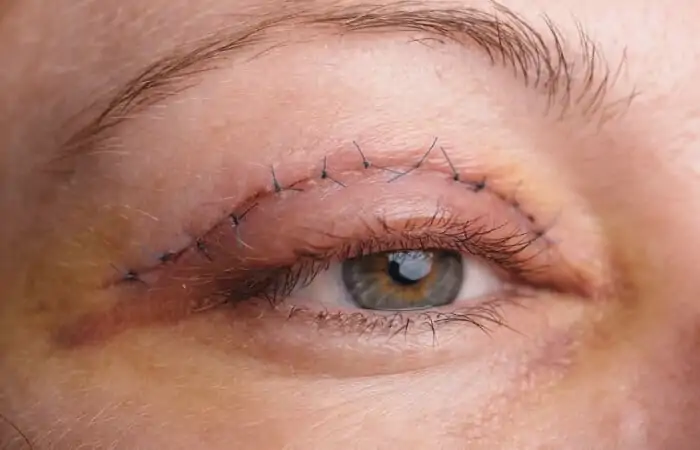 عملية شد الجفون